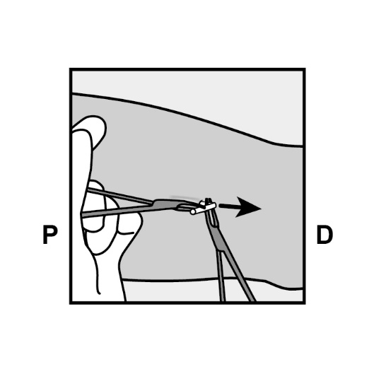 Milotden_200042_18MRL_Nexplanon_FIG_18_V3