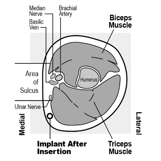 Milotden_200042_18MRL_Nexplanon_FIG_2c_V3