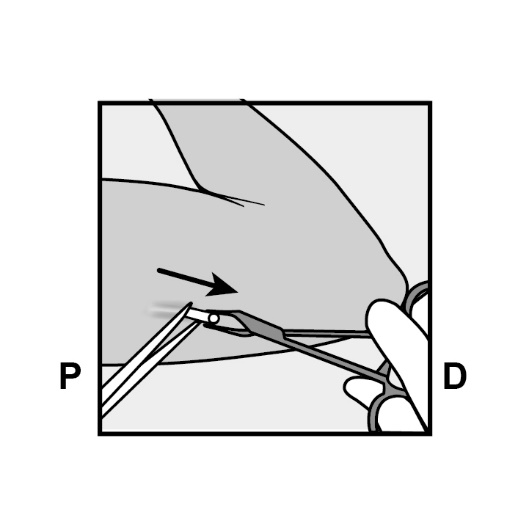 Milotden_200042_18MRL_Nexplanon_FIG_15_V3