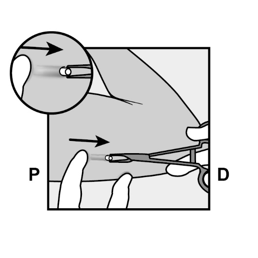 Milotden_200042_18MRL_Nexplanon_FIG_13_V3