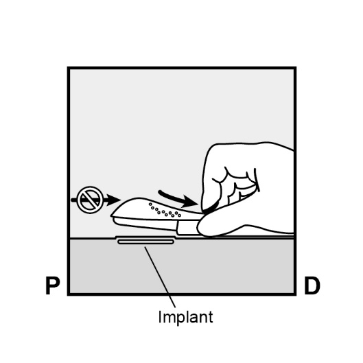 Milotden_200042_18MRL_Nexplanon_FIG_8B_V3