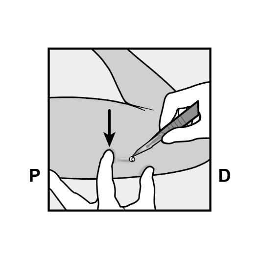Milotden_200042_18MRL_Nexplanon_FIG_12_V3