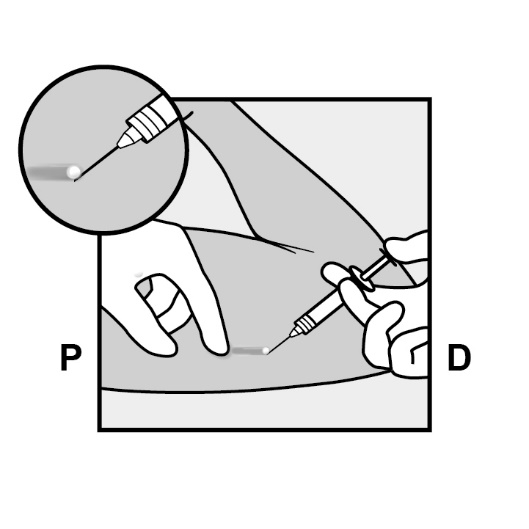Milotden_200042_18MRL_Nexplanon_FIG_11_V3