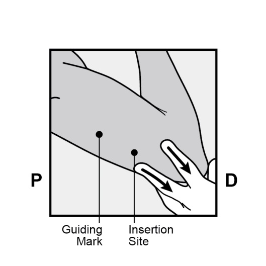 Milotden_200042_18MRL_Nexplanon_FIG_4_V3