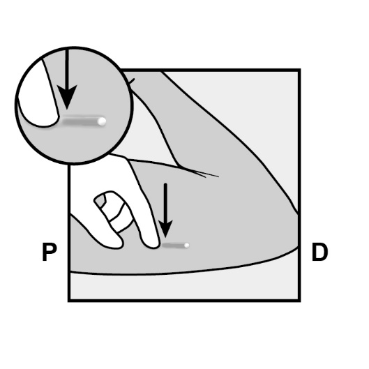 Milotden_200042_18MRL_Nexplanon_FIG_10_V3