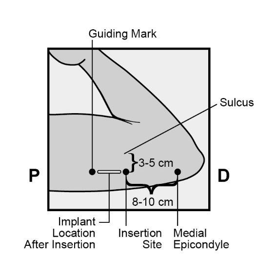 Milotden_200042_18MRL_Nexplanon_FIG_2A_V4