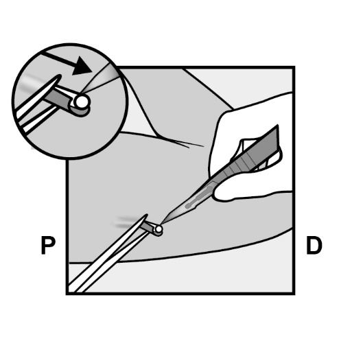 Milotden_200042_18MRL_Nexplanon_FIG_14_V3