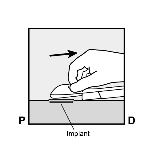 Milotden_200042_18MRL_Nexplanon_FIG_8C_V3