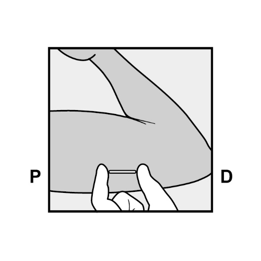 Milotden_200042_18MRL_Nexplanon_FIG_9_V3