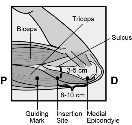 Milotden_200042_18MRL_Nexplanon_FIG_2B_V3